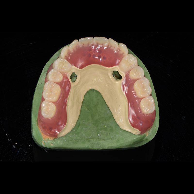 Removable Telescopic Partial Denture China Dental Lab For Missing Teeth