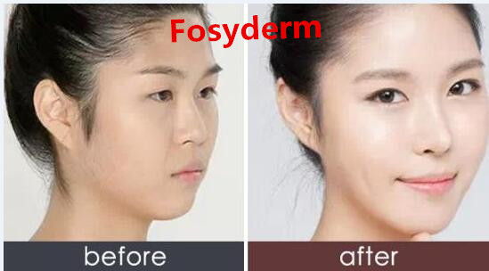 Hyaluronic Acid Gel Wrinkle Filler Injections For Removing Crows Feet 1ml