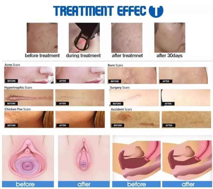 Medical Fractional Laser Beauty Machine System Control 10600nm Wavelength fractional co2 laser
