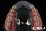 Precision Removable Prosthesis Dental Implant Attachments Easy Clean Comfortable