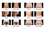 Multifunctional double chin removal weight loss cryo cool sculpting cavitation