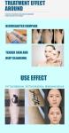 Customized Q Switched Nd Yag Laser Machine Clinical Q Switched Laser Tattoo