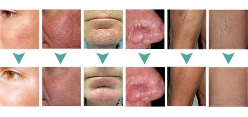 Varicose veins laser treatment machine spider veins on face removal laser surgery for varicose veins