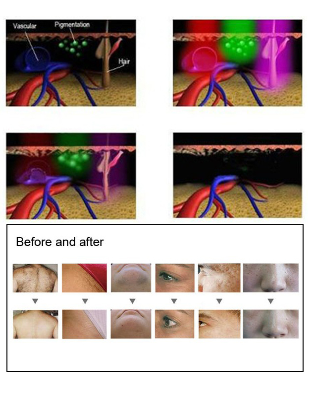DPL 480nm Elight SHR IPL Hair Removal 530NM Led Skin Rejuvenation Machine