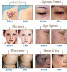 Q Switch Nd YAG Laser Tattoo Removal Machine 1064nm 532nm 1320nm 2 Years