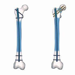 Quality Precice Ti Alloy Surgery Interlocking Nail Femur Mechanical Stable wholesale