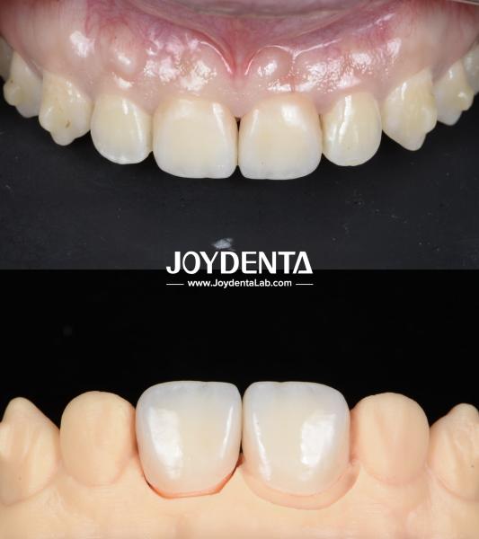 Lightweight Smooth Surface Zirconia Dental Bridges For Implant Supported