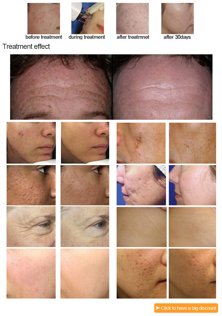Safe 1550 Er Yag Laser Lifotronic Fractional Erbium Glass Laser for Skin Resurfacing