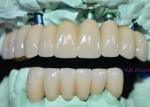 OEM Implant Zirconia Dental Crown Fixed Bridge