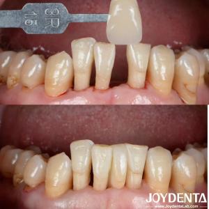 Quality Natural Shape Ceramic Maryland Bonded Bridge Dental Restorations Excellent Aesthetics wholesale