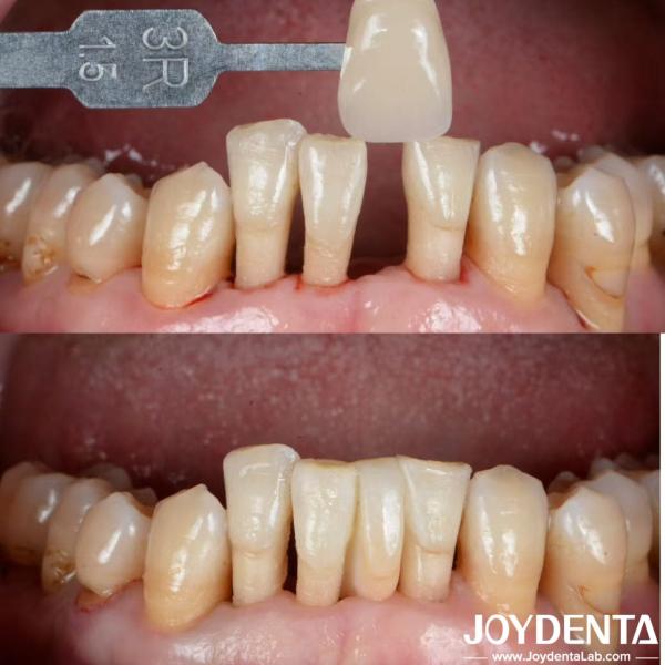 Natural Shape Ceramic Maryland Bonded Bridge Dental Restorations Excellent