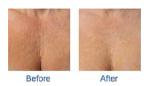 The most efficient wrinkle removal facial massage machine hifu body slimming