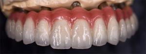 Quality Staining Resistance Dental Lab Crowns For Various Tooth Replacements wholesale
