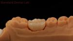 Dental Digital Full Zirconia Crown with Noritake Porcelain 3D Print Model 5 Year
