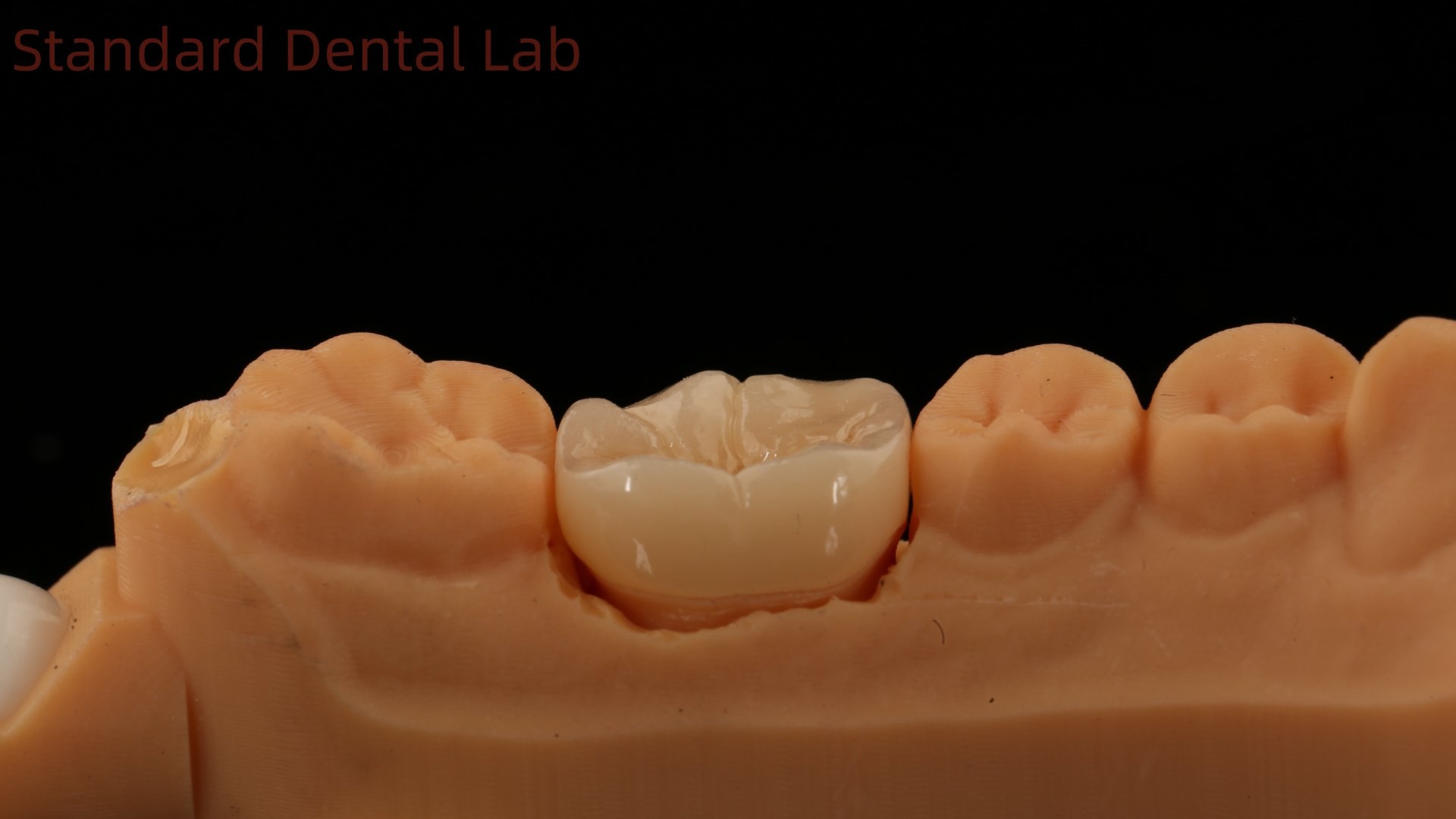 Dental Digital Full Zirconia Crown with Noritake Porcelain 3D Print Model 5 Year Guarantee