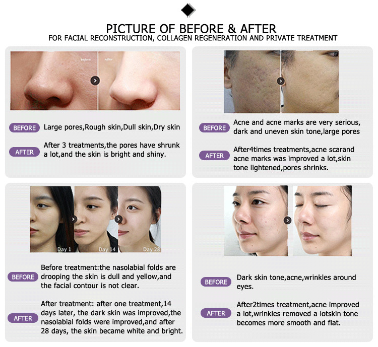china skin resurfacing machine vaginal scanxel round fotona fractional co2 laser with 3 heads