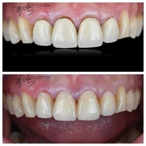 Quality Comfortable Zirconia Dental Bridges Lightweight Natural Color Transitions For Optimal Patient Experience wholesale
