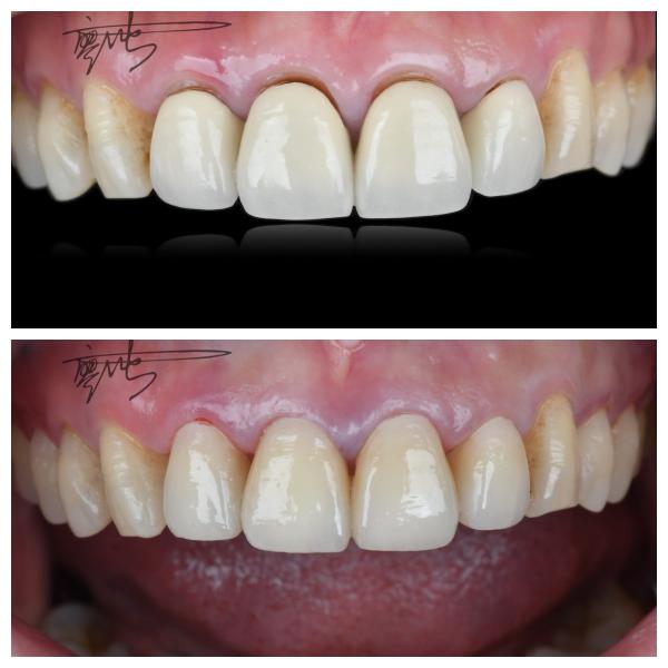 Comfortable Zirconia Dental Bridges Lightweight Natural Color Transitions For