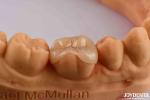 High Durability Dental Inlay Onlay Composite Natural Looking Appearance