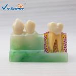 Decayed Tooth Orthodontic Study Models 4 Times Caries Disassembling Model