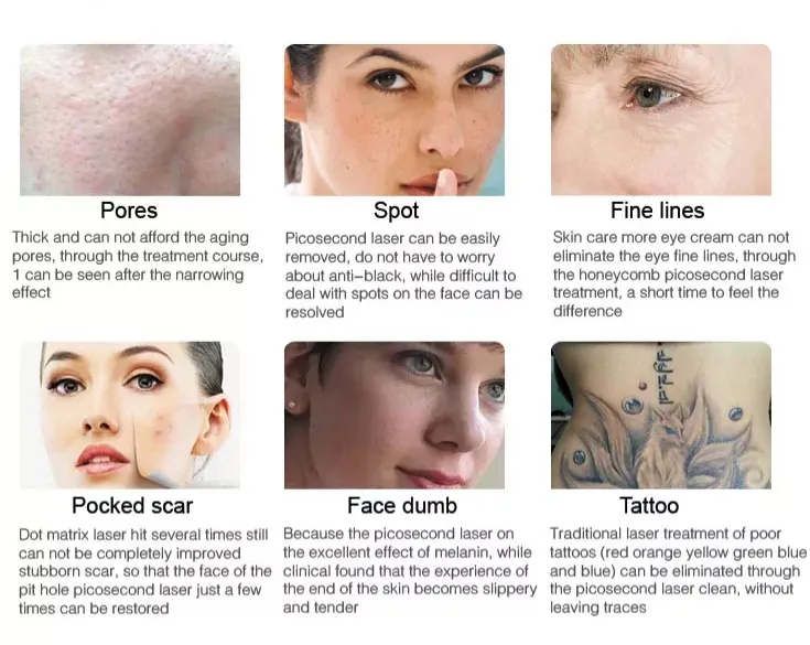 J12 Q Switched Nd Yag Laser Tattoo Removal Machine With 1064Nm 532Nm 1320Nm Nd-Yag Pigmentation Removal Skin Whitening