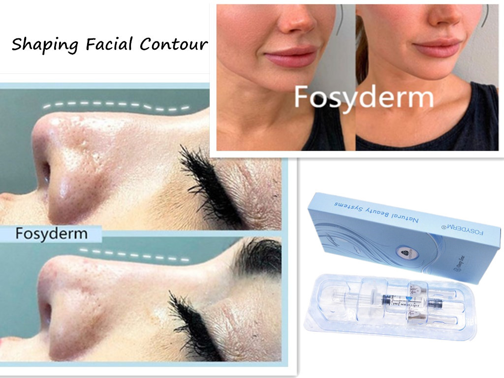 Clear Fosyderm Facial Chin Hyaluronic Acid Dermal Filler BD Syringe For Nose