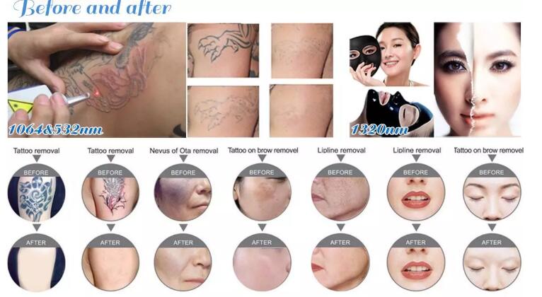 Portable Q Switch ND Yag Laser Machine 1500W With 8.4 Touch Screen