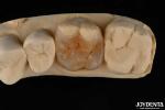 E Max Material Inlay And Onlay In Dentistry Aesthetic Restoration Long Lasting