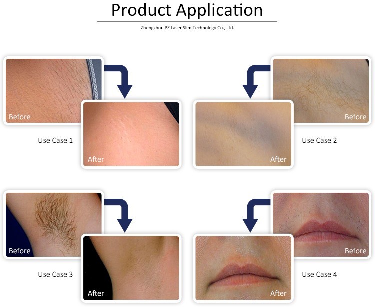 Painless Fast Diode Laser Hair Removal Machine Skin Rejuvenation Equipment