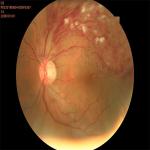 CCD Non Mydriatic Fundus Camera Retinal Imaging No Pain