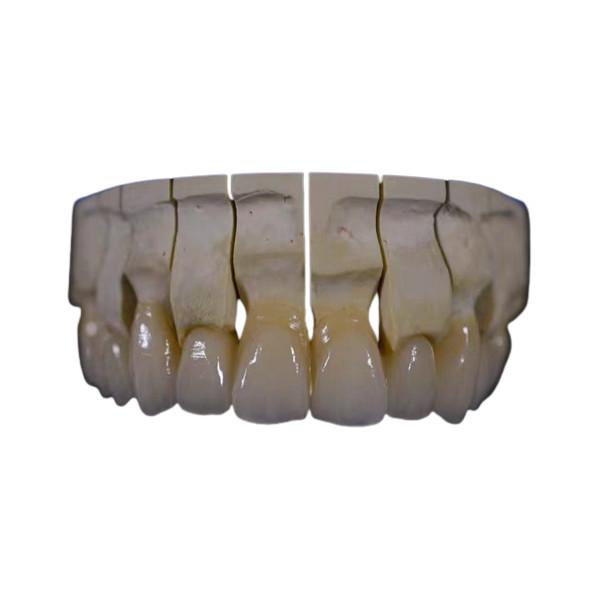 Full Mouth Zirconia Dental Crown Restoration Zirconia Fixed Bridge Chemical
