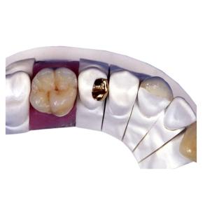 Quality PFM Porcelain Dental Crown wholesale