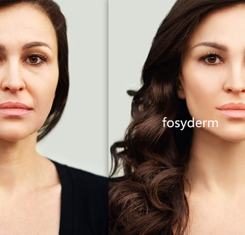 2ml HA Injectable Dermal Filler For Fine Wrinkles