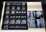 Waterproof 215 Micron PET Based Medical X Ray Film