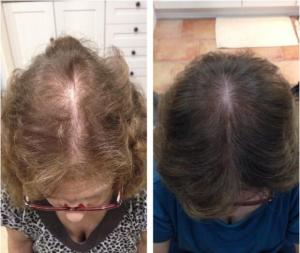 Quality hair loss laser cap wholesale