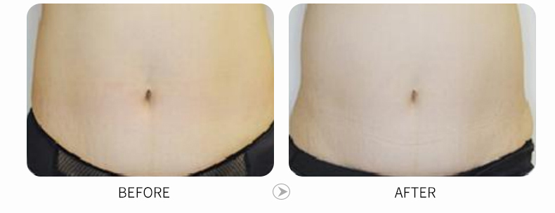 cryo fat freezing.jpg