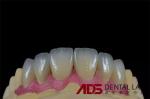 Handcrafted Porcelain Feldspathic Dental Veneer Natural Looking