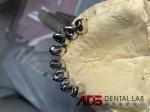 China Dental Lab Dental Implant Attachments Adjustable Telescopic