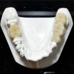 Unwavering Quality The Mark Of Our Ceramic Dental Crowns