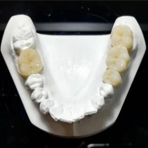 Quality Unwavering Quality The Mark Of Our Ceramic Dental Crowns wholesale