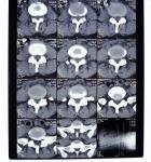 8in* 10in 14in * 17in High Density Medical X-ray Dry Thermal Printer Film