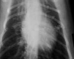 Low Fog 11 x 14 Paper Xray Film For Medical Laser Printers KND-K
