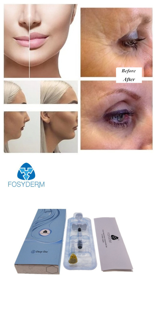Injectable Hyaluronic Acid Dermal Filler For Facial Deep Wrinkle