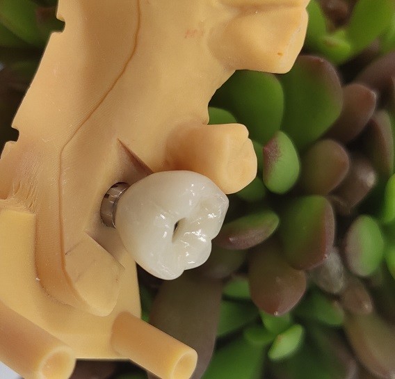 Great Biocompatibility ANKYLOS Dental Implant Supported Crown