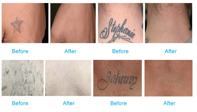 Laser tattoo removal q-switched nd:yag laser carbon peel/Q switched nd yag laser /tattoo removal beauty machine