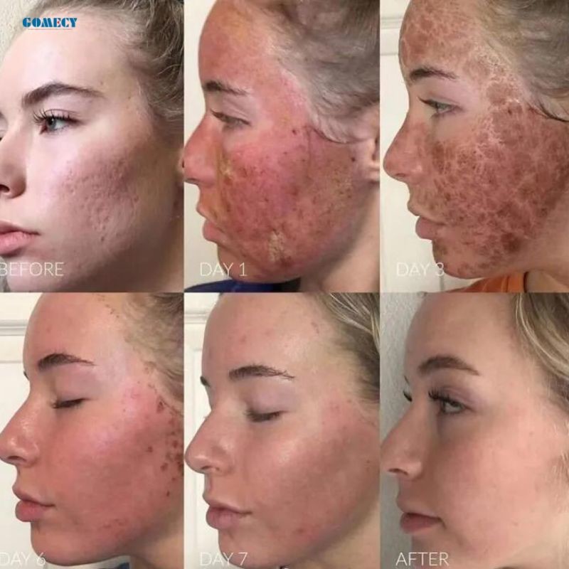 CO2 Fractional Laser Device with Touchscreen Interface for Advanced Skin Therapy Wrinkle Removal and Lifting