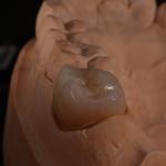 Full Contour Translucent Zirconia Crown for Aesthetically Pleasing Results