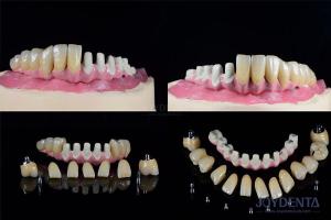Quality Multiple Endosseous Dental Implants Internal Connection For Full Arch Restoration wholesale