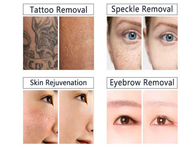 Tattoo Removal ND YAG Laser Machine