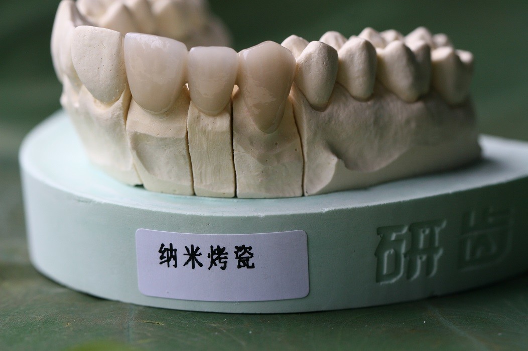 Metal Framework PFM Dental Crown